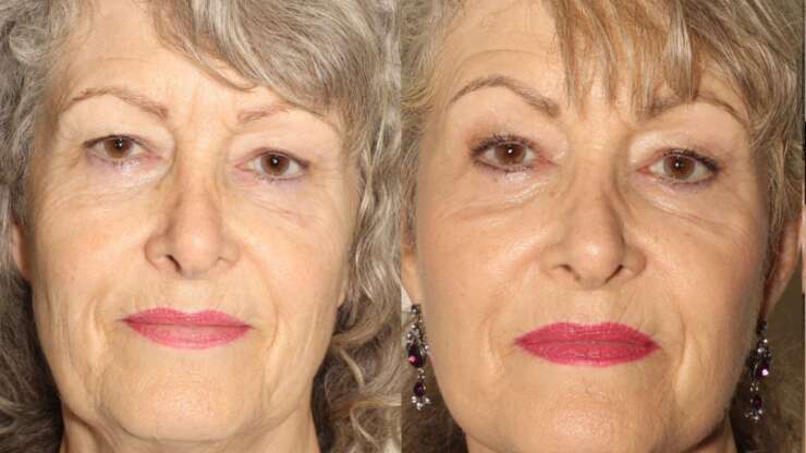 Facelift, Neck Lift, Upper Blepharoplasty and Laser Resurfacing (Facelift Vancouver)