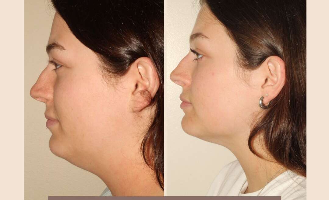 Facial Liposuction and Beyond: Sculpting Your Jawline and Neck for a Refined Profile
