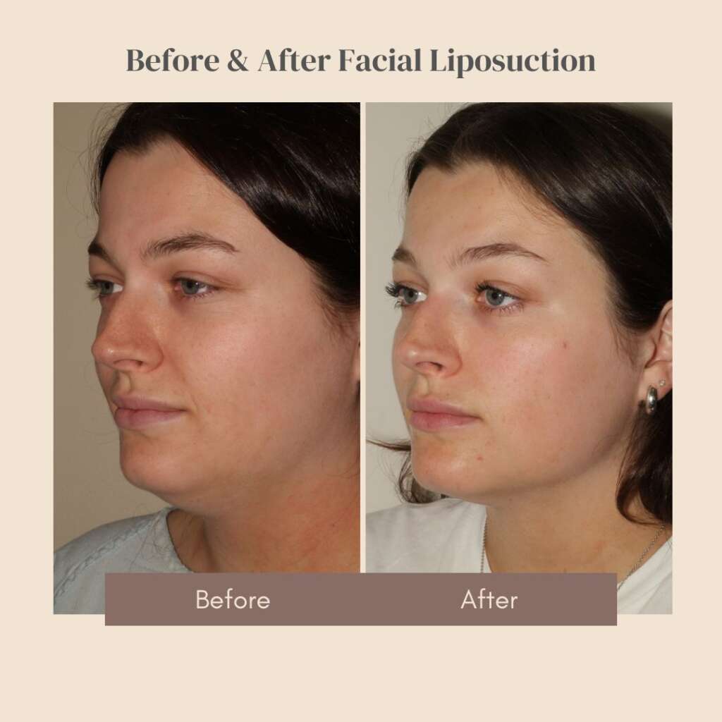 before and after photos of a young woman who has undergone facial liposuction