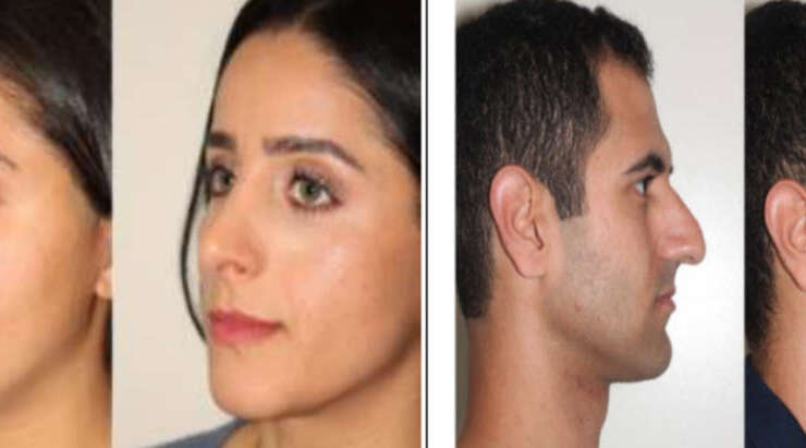 Are There Differences Between Male and Female Rhinoplasty?