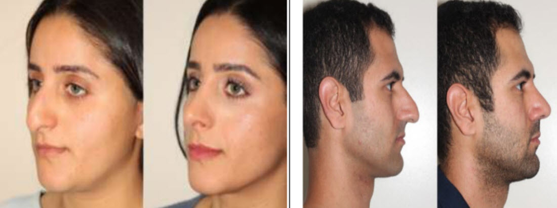 Are There Differences Between Male and Female Rhinoplasty?