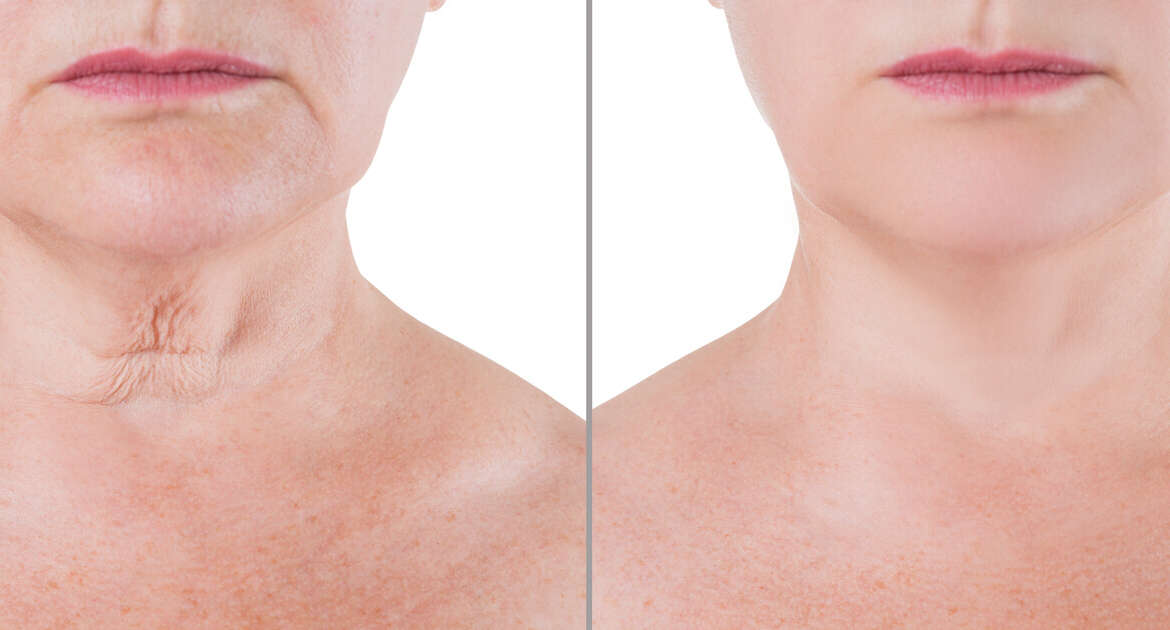 What is A Neck Lift?