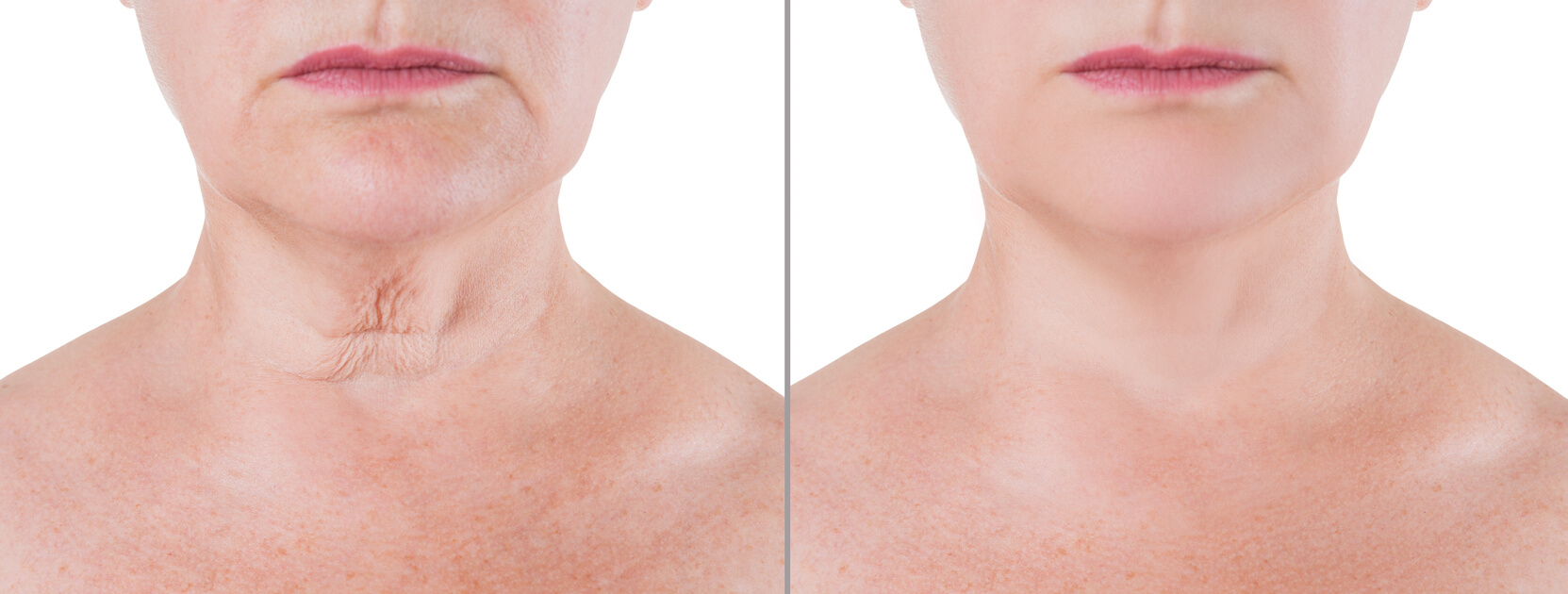 Skin rejuvenation on the neck, before after anti aging concept, wrinkle treatment, facelift and neck lift surgery, half of body isolated on white background
