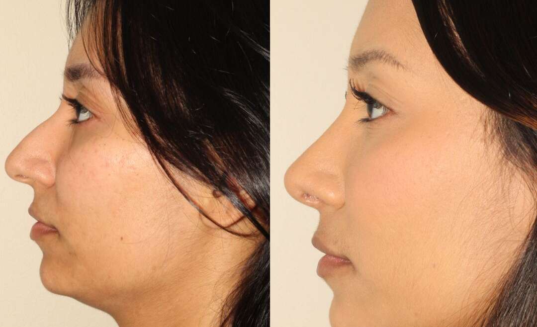 Rhinoplasty in Vancouver: Addressing Your Top Concerns About Nose Surgery