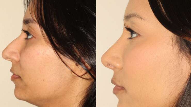 Rhinoplasty in Vancouver: Addressing Your Top Concerns About Nose Surgery