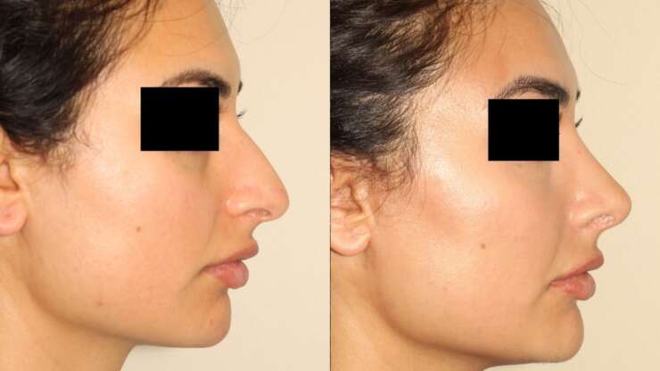 What You Need To Keep In Mind If You’re Considering A Rhinoplasty (Nose Job)