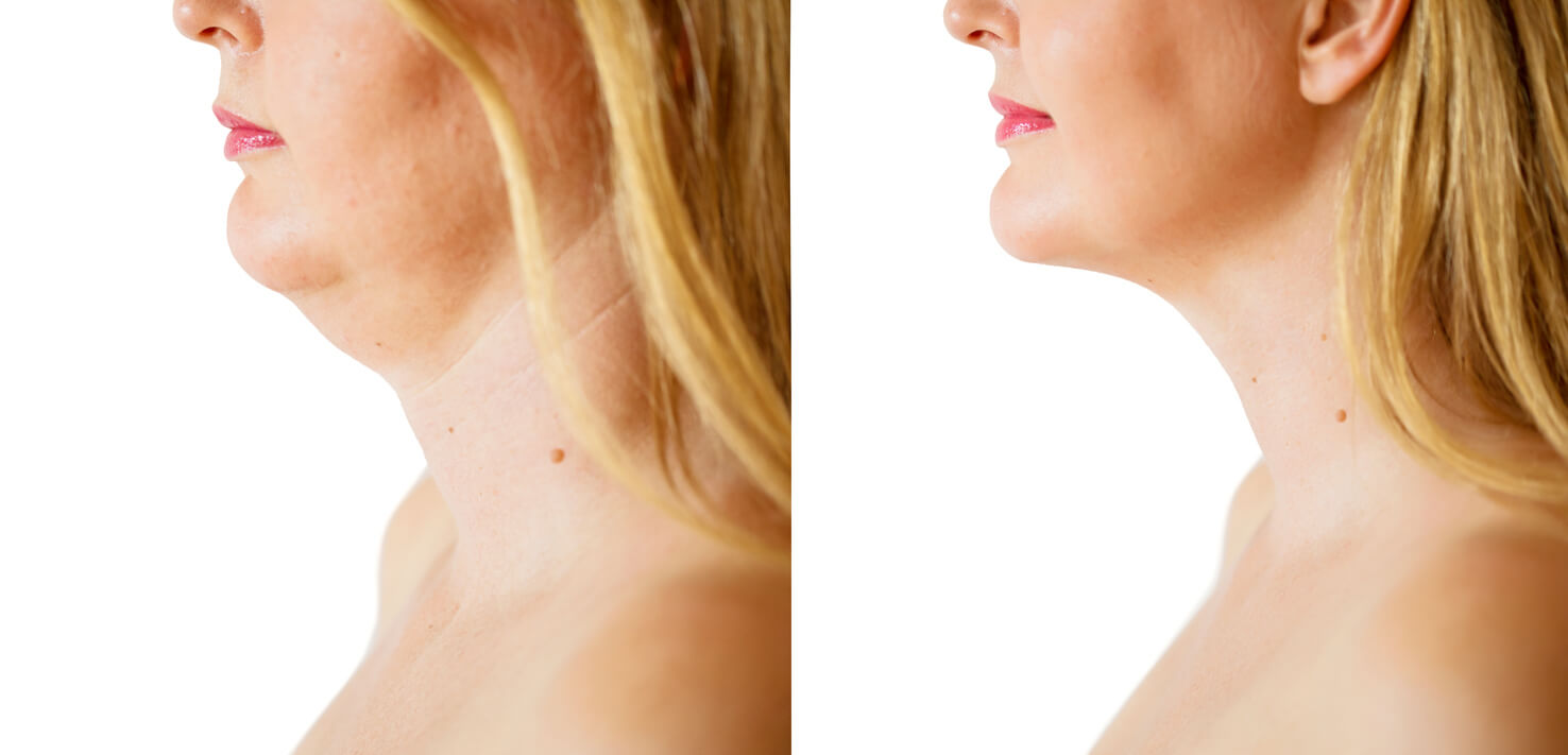 Caucasian ethnicity female before and after submentoplasty correction procedure